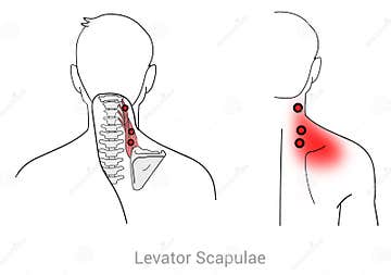 Levator Scapulae stock illustration. Illustration of treatments - 304713502