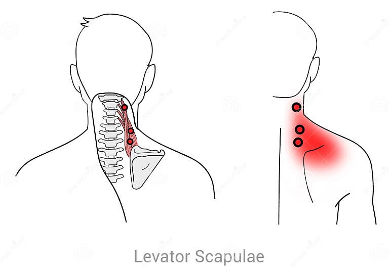 Levator Scapulae stock illustration. Illustration of treatments - 304713502