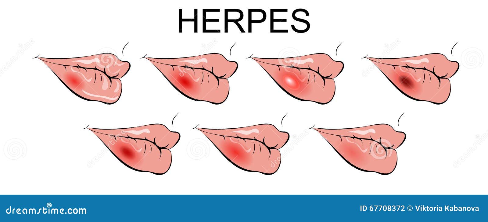 Herpes Pictures HD - Symptoms, Images, Photos and Pictures of Herpes