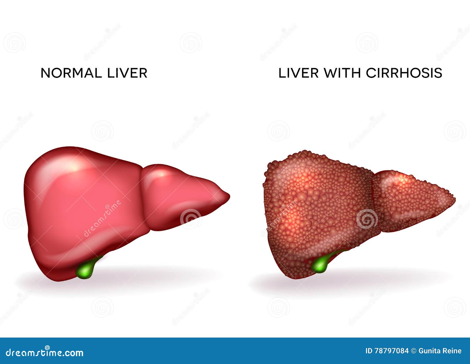 Normal Healthy Liver and Liver with Cirrhosis Stock Vector ...