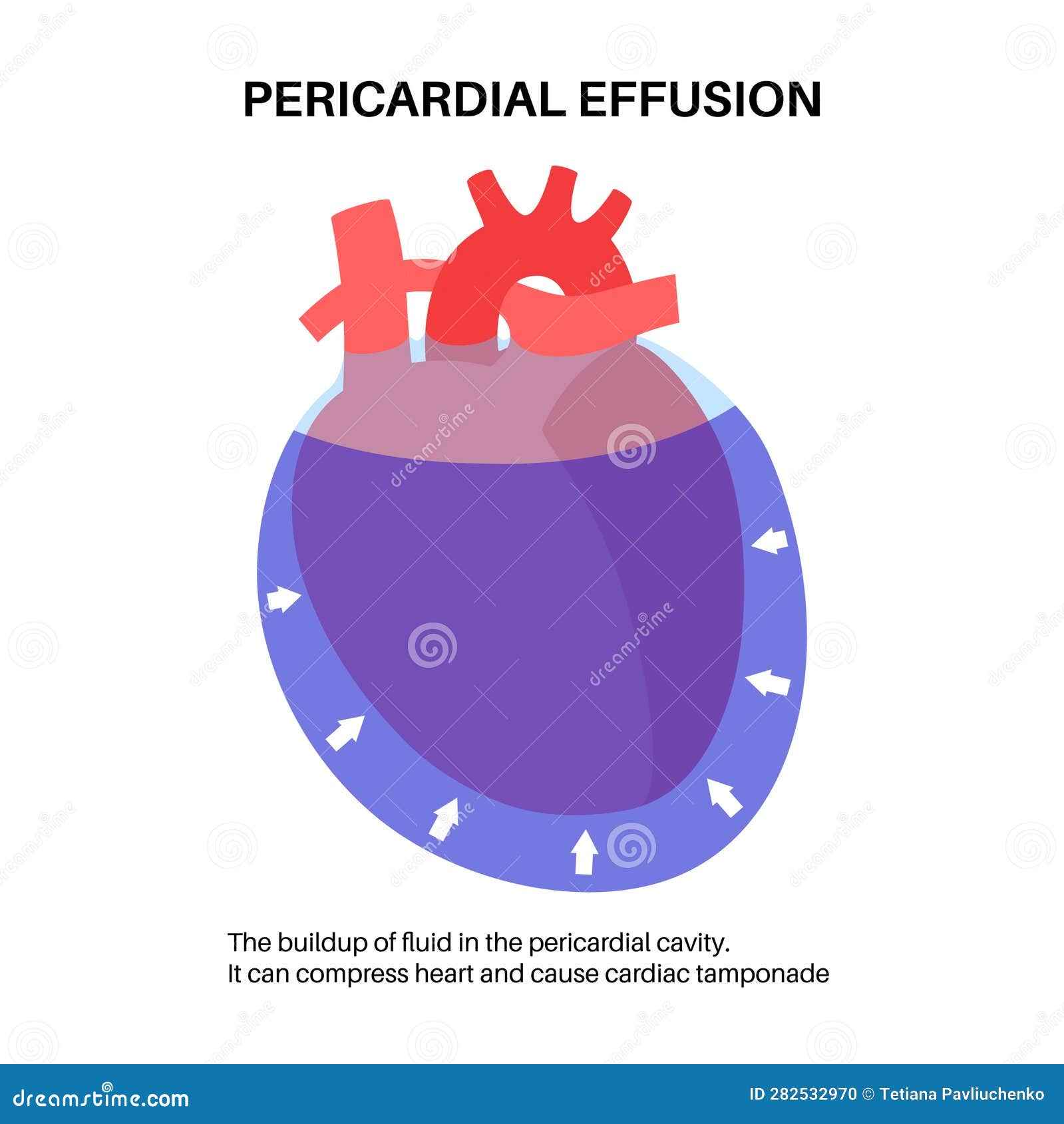 Cardiac Tamponade Diagram