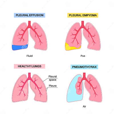 Pleural effusion poster stock vector. Illustration of empyema - 275759295