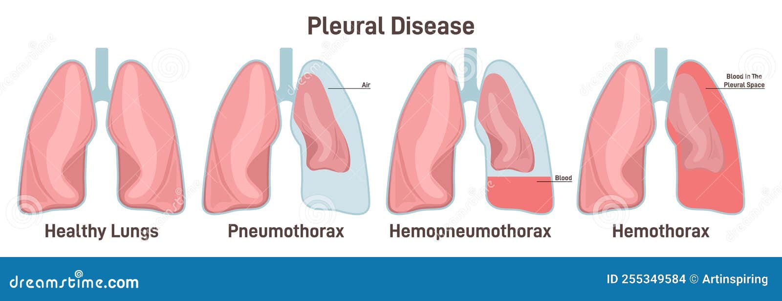 Pleural Effusions. Abnormal Gathering of Blood or Air in Pleural Space ...