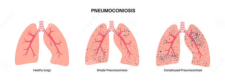 Pneumoconiosis Lung Disease Stock Vector - Illustration of personal ...