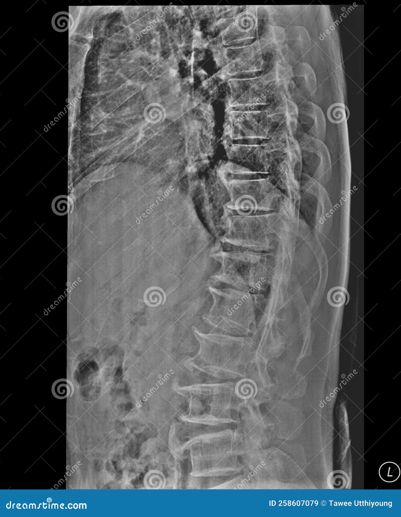 Scoliosis Film X-ray Lumbar Spine Stock Image - Image of hospital ...