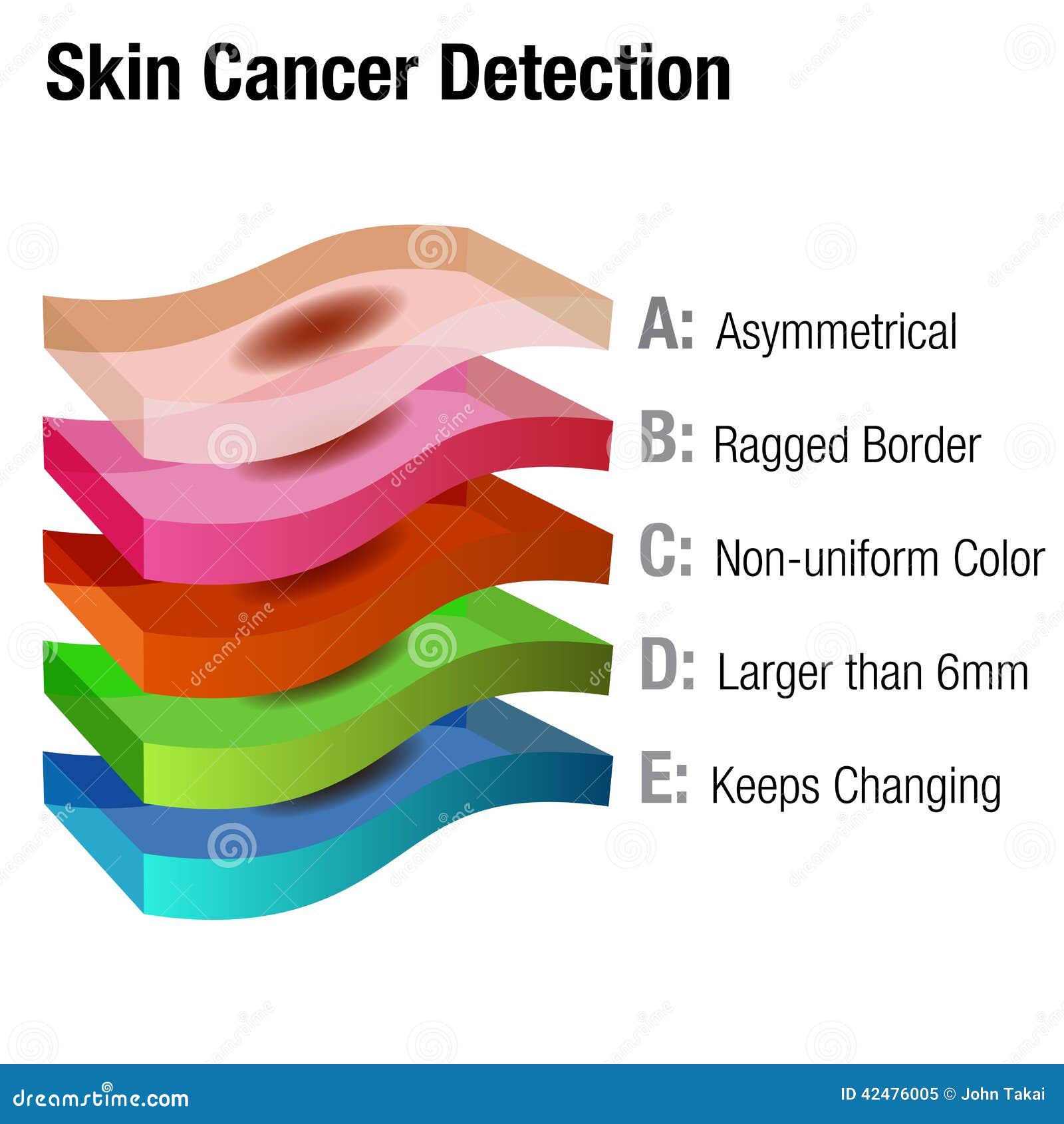 Skin Cancer Chart Pictures - Skin Cancer Types Skincancer Net