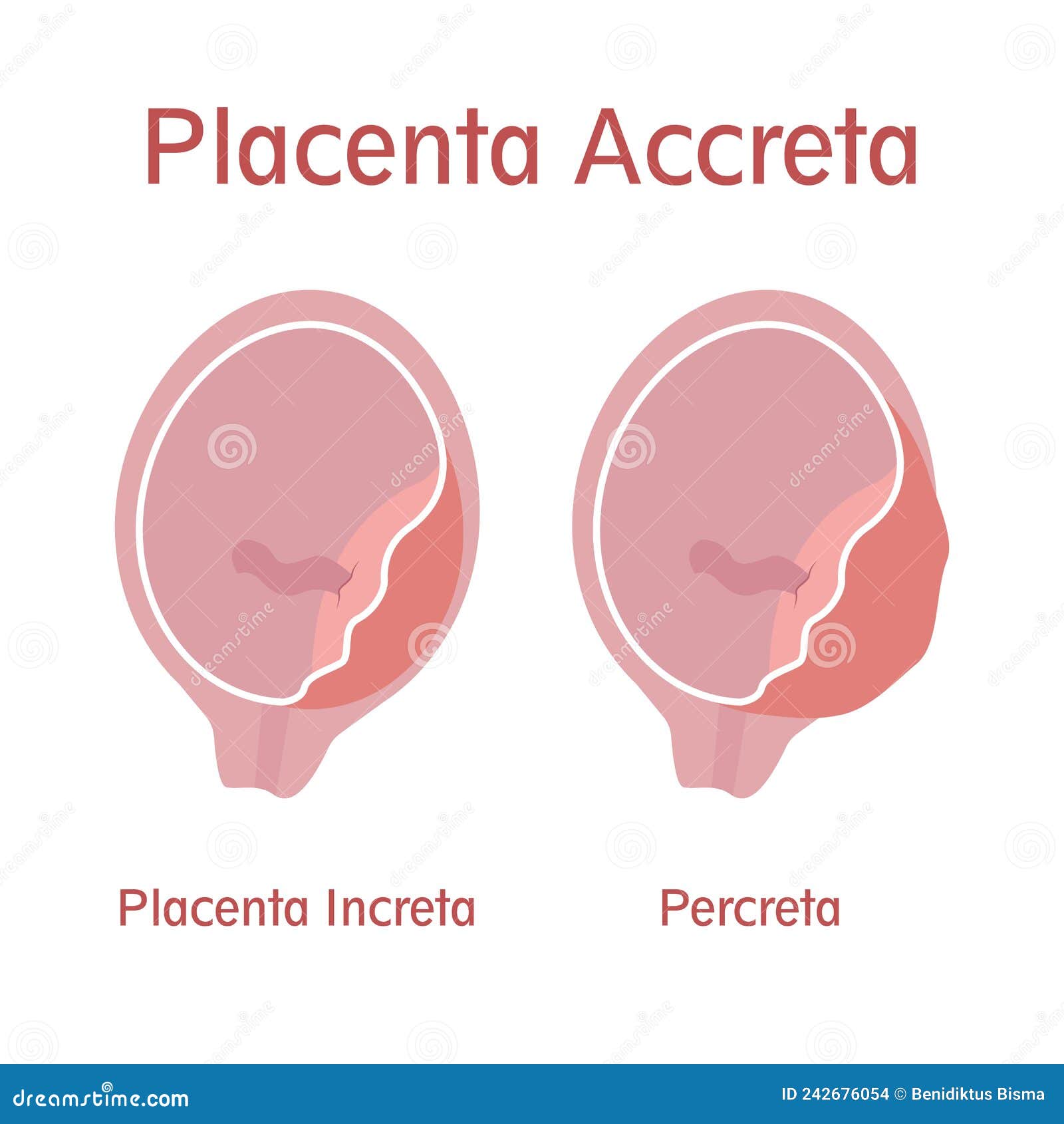 Placenta Acreta Increta E Percreta - RETOEDU