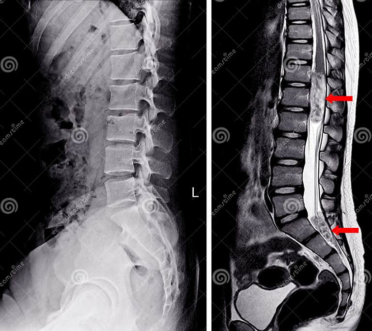 X-ray and MRI Lumbar spine stock illustration. Illustration of hospital ...