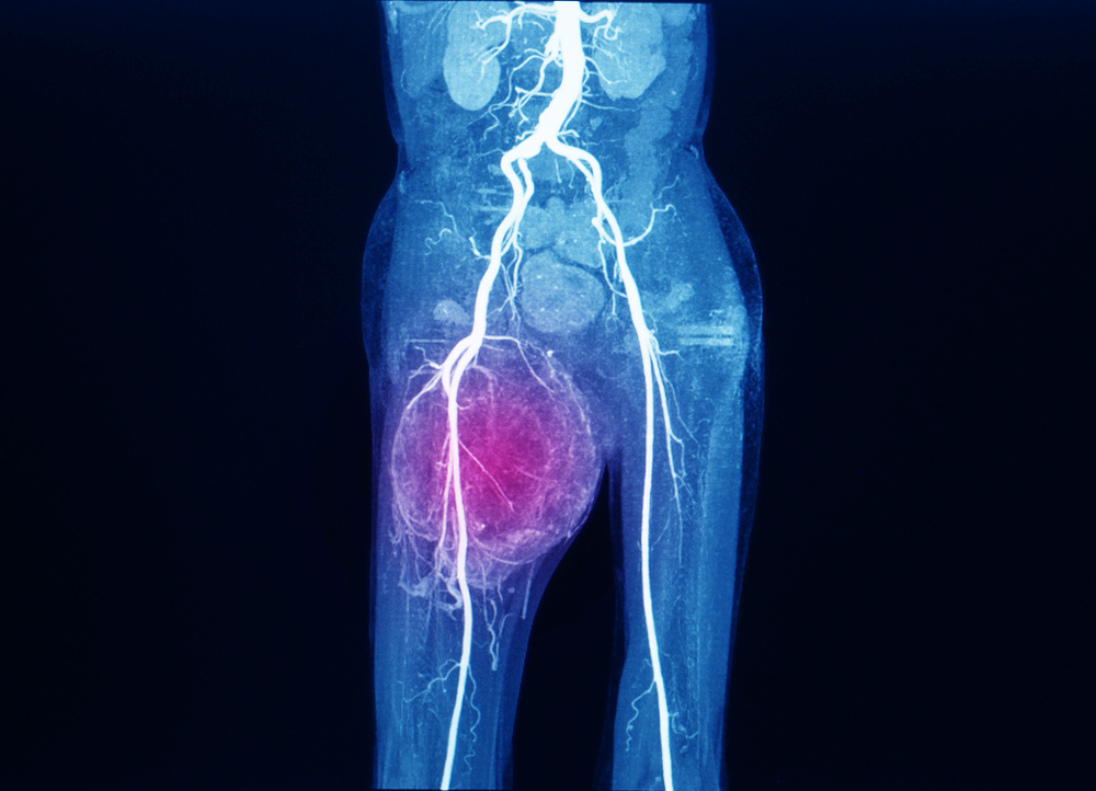 another type of soft tissue sarcoma