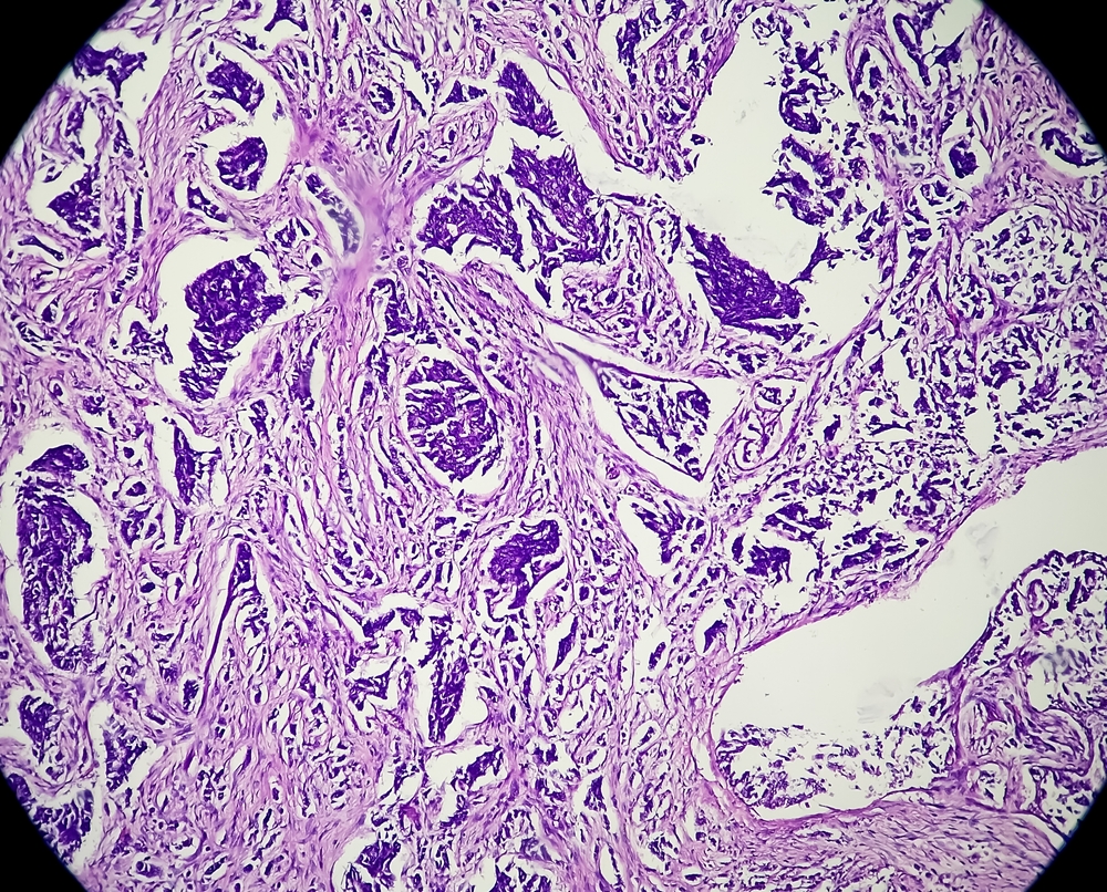 a type of soft tissue sarcoma