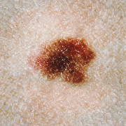 Dysplastic nevi mole on skin