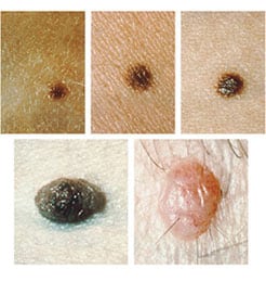 common moles