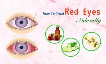 how to treat red eyes