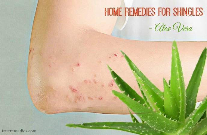 home remedies for shingles - aloe vera