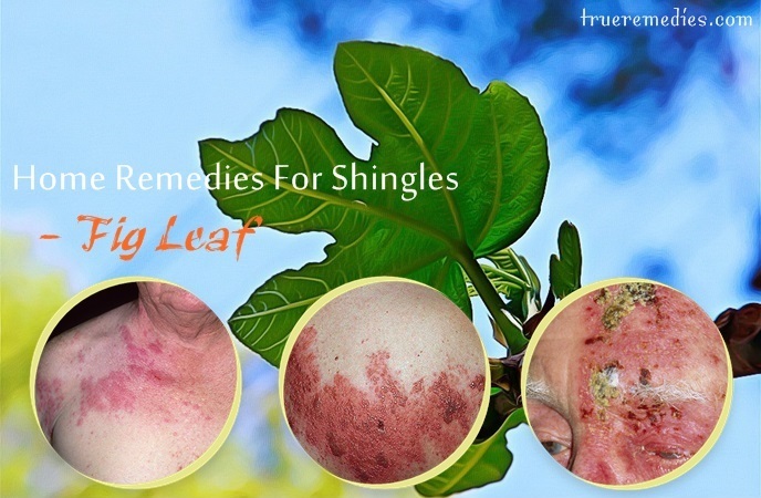 home remedies for shingles - fig leaf