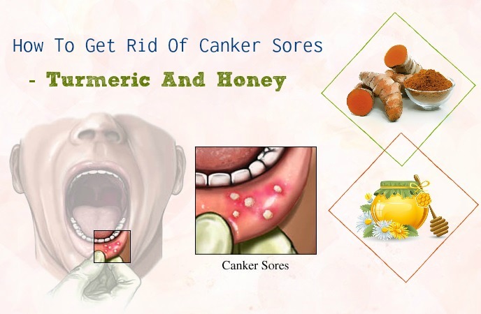 how to get rid of canker sores - turmeric and honey