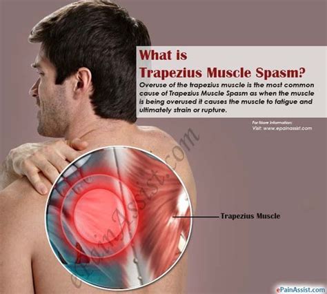 Trapezius Muscle Tear