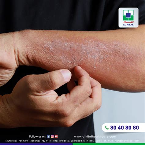 Dermatitis: Symptoms, Diagnosis, Treatment, and Prevention