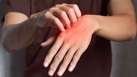 Rashes – Occupational Health Services