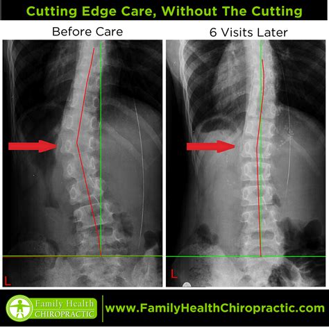 Scoliosis Treatment | FamilyHealthChiropractic.com