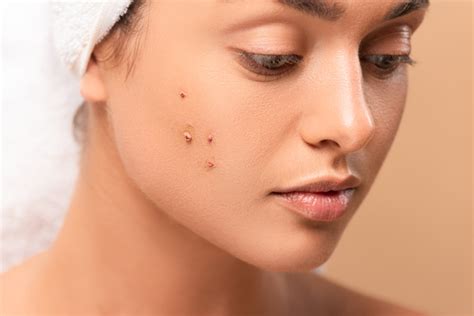 Close up of girl with acne on face isolated on beige Free Stock Photo ...