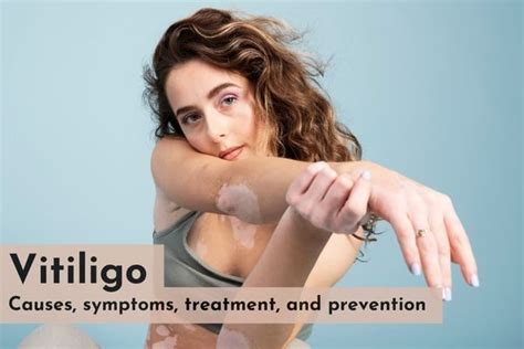 Vitiligo: Causes, symptoms, treatment, and prevention - SkinQure