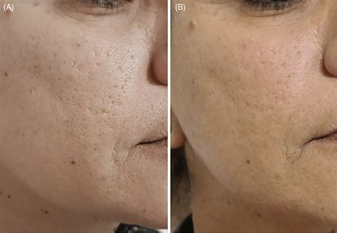 Treatment of acne scars with fractional laser (two sessions). (A ...