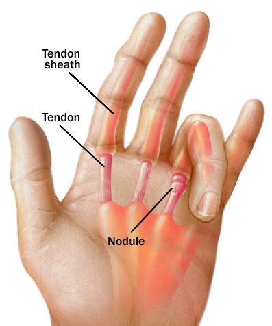 Common Causes of Finger Stiffness - The Orthopaedic Institute