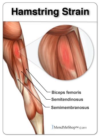 Hamstring Strain Information