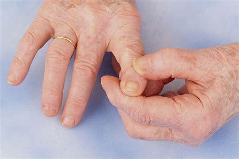 Treatment Recommendations for Hand Osteoarthritis