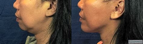 Laser Facelift – Murrieta Facial Plastic Surgery