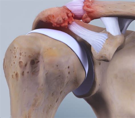 Acromioclavicular Joint Problems - Dr. Erik Hohmann