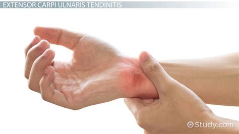 Extensor Carpi Ulnaris Tenosynovitis