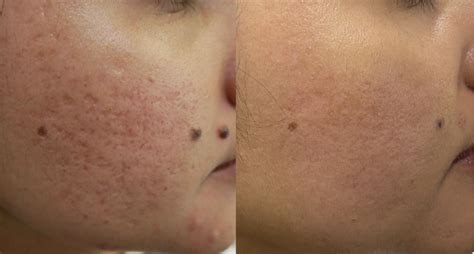 CO2 Laser Resurfacing For Acne Scars - Cutis Dermatology