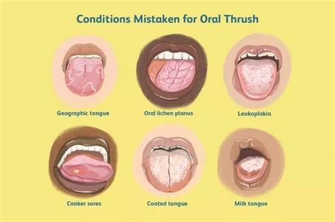 Tongue thrush | News | Dentagama