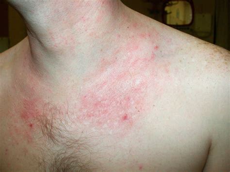 Atopic dermatitis causes, symptoms, diagnosis, treatment & prognosis