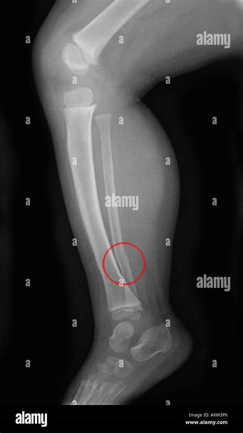 x-ray of an infant showing a fracture of the tibia and fibula of the ...