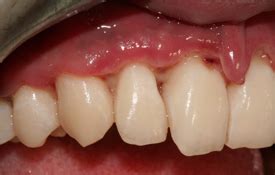 Necrotizing Ulcerative Gingivitis Before And After