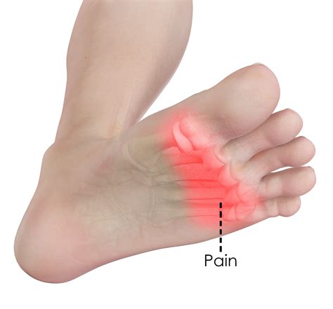 Pain Under Foot Causes at Trevor Brown blog