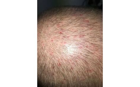 Scalp Folliculitis