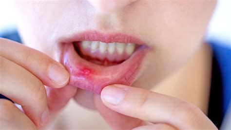 Mouth Sores: Causes, Symptoms & Treatment - Dr. Salim Kapadia Dental Centre