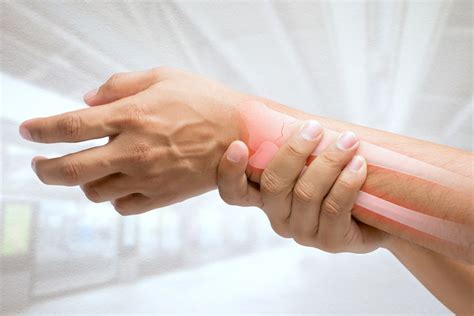 Wrist Fracture Recovery - AICA Orthopedics