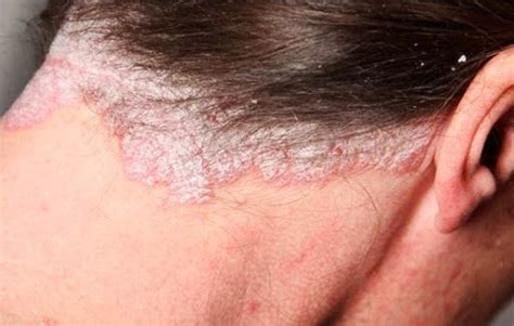 Penyakit Kulit Psoriasis – newstempo