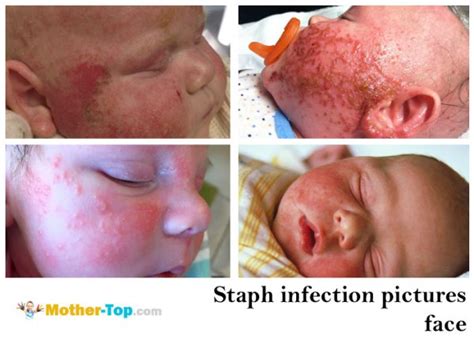 Staph infection and MRSA symptoms in newborns | mother-top.com