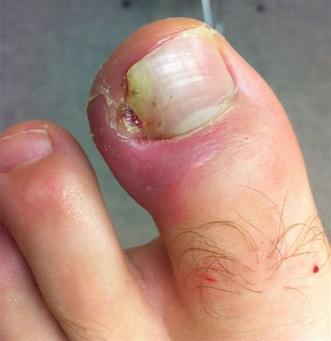 Ingrown Toenail Treatment Brisbane The Ingrown Toenail Ctr