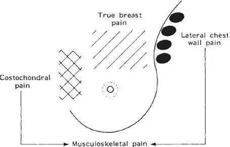 Breast Pain Treatment Melbourne | Mastalgia Melbourne | Richmond VIC