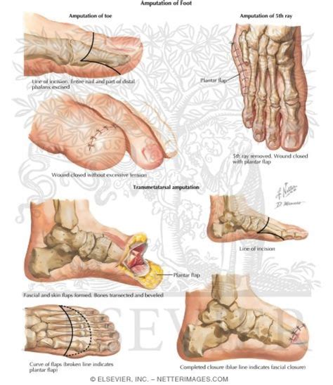 Toe Amputation - Transmetatarsal Amputation