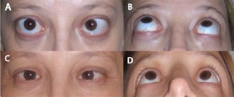 Patient with Graves disease who underwent bilateral orbital ...