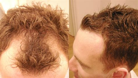 About Receding Hairline and Its Treatment - Fashion Unlock