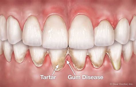 Periodontal Flap Surgery | Coastal Periodontics & Implant Dentistry ...